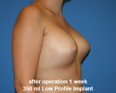 plastic-surgery-breast-augmentation